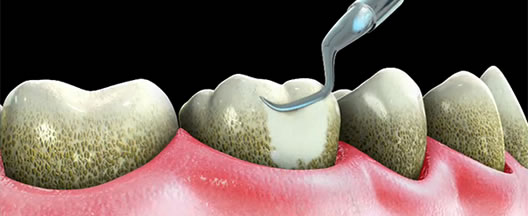 Чистка зубок, удаление зубного камня